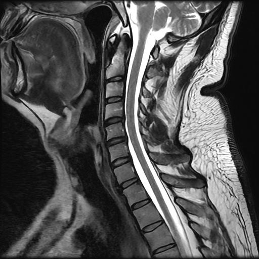 Resonancia magnética de columna cervical, corte sagital ponderado en T2.
