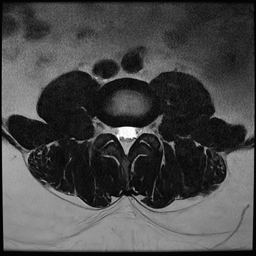 Resonancia magnética de columna lumbar, corte axial ponderado en T2.