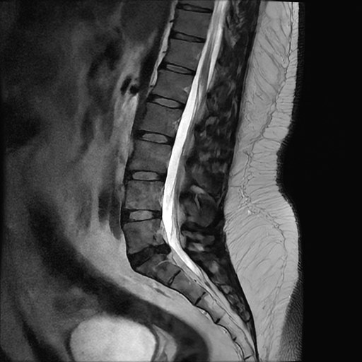 Resonancia magnética de columna lumbar, corte sagital ponderado en T2.