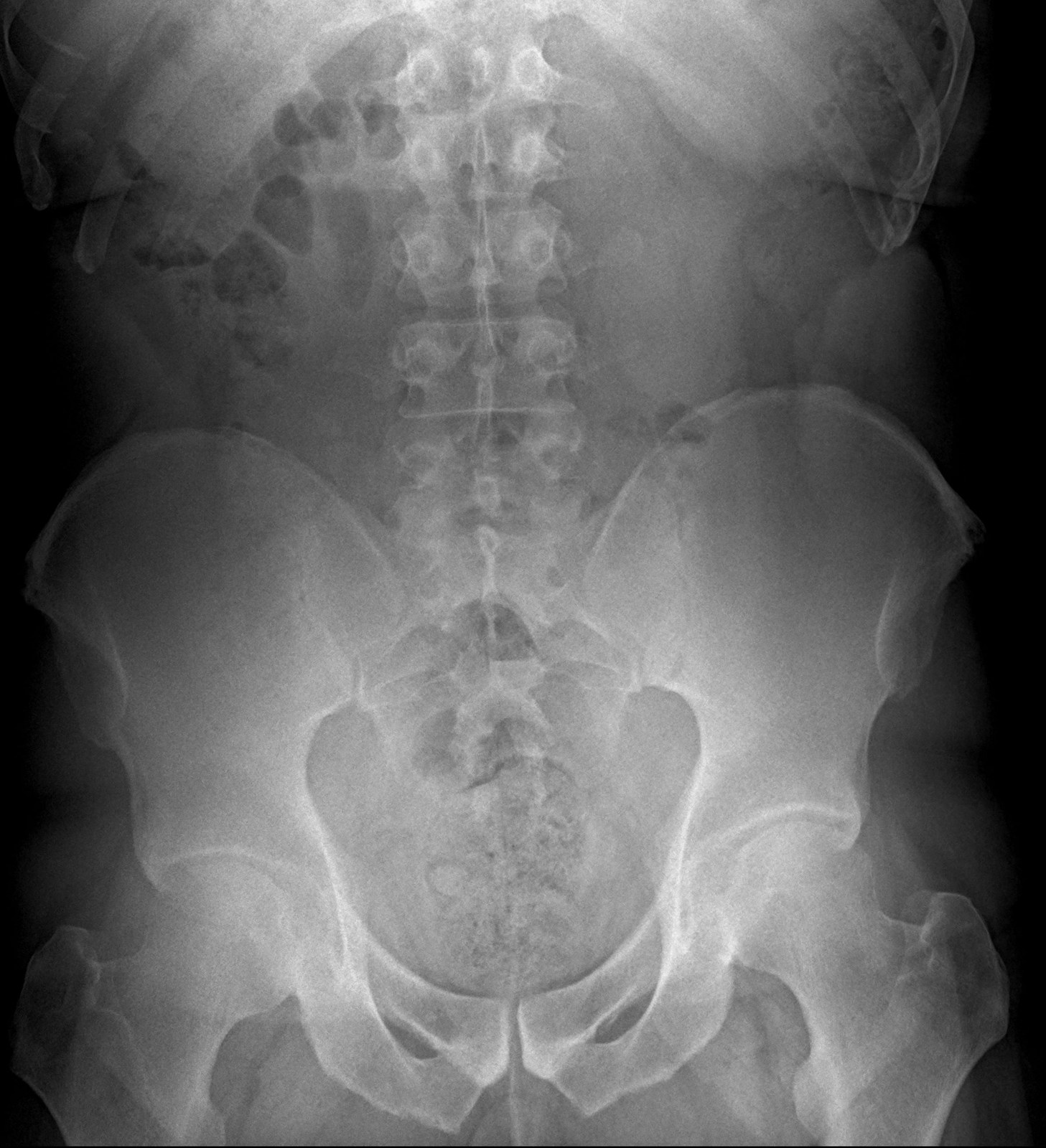 Radiografía de columna lumbar, proyección anteroposterior.